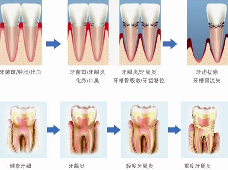 牙龈炎与牙周病