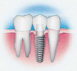 牙龈萎缩能做种植牙吗?