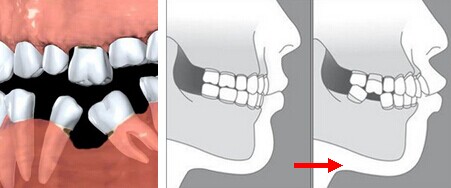 牙体缺失，牙齿位移
